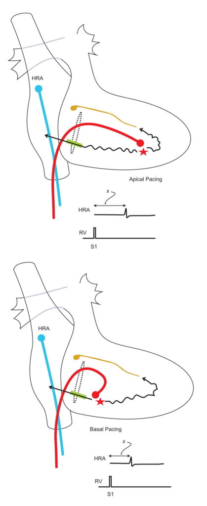 Differential Pacing for accessory pathways | EP Made Easy!