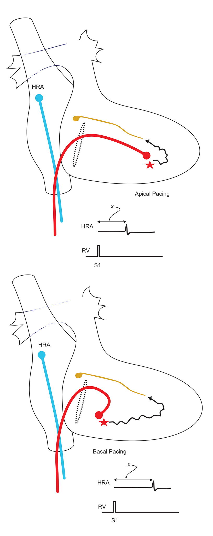 Differential pacing for accessory pathways - nodal response