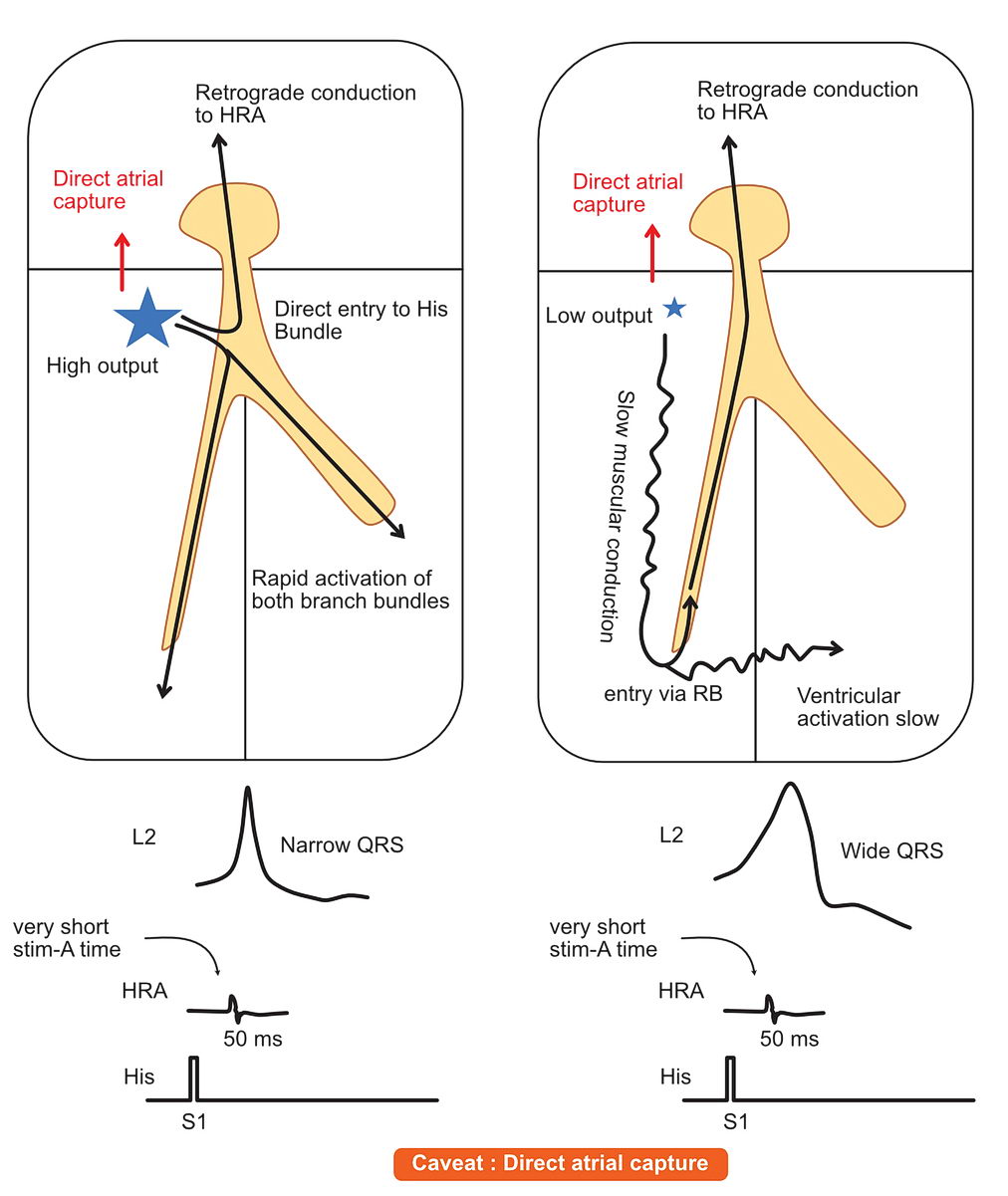 Parahisian pacing - caveat - direct atrial capture