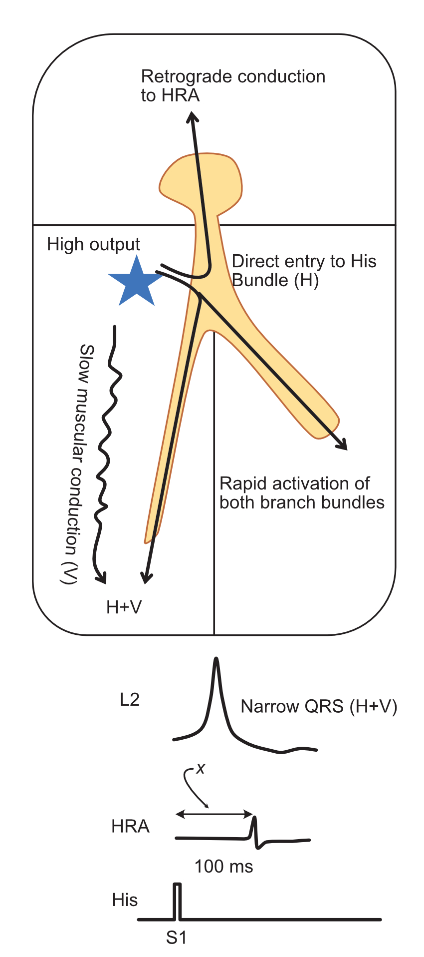 Parahisian pacing - capture of His bundle and myocardium at high output