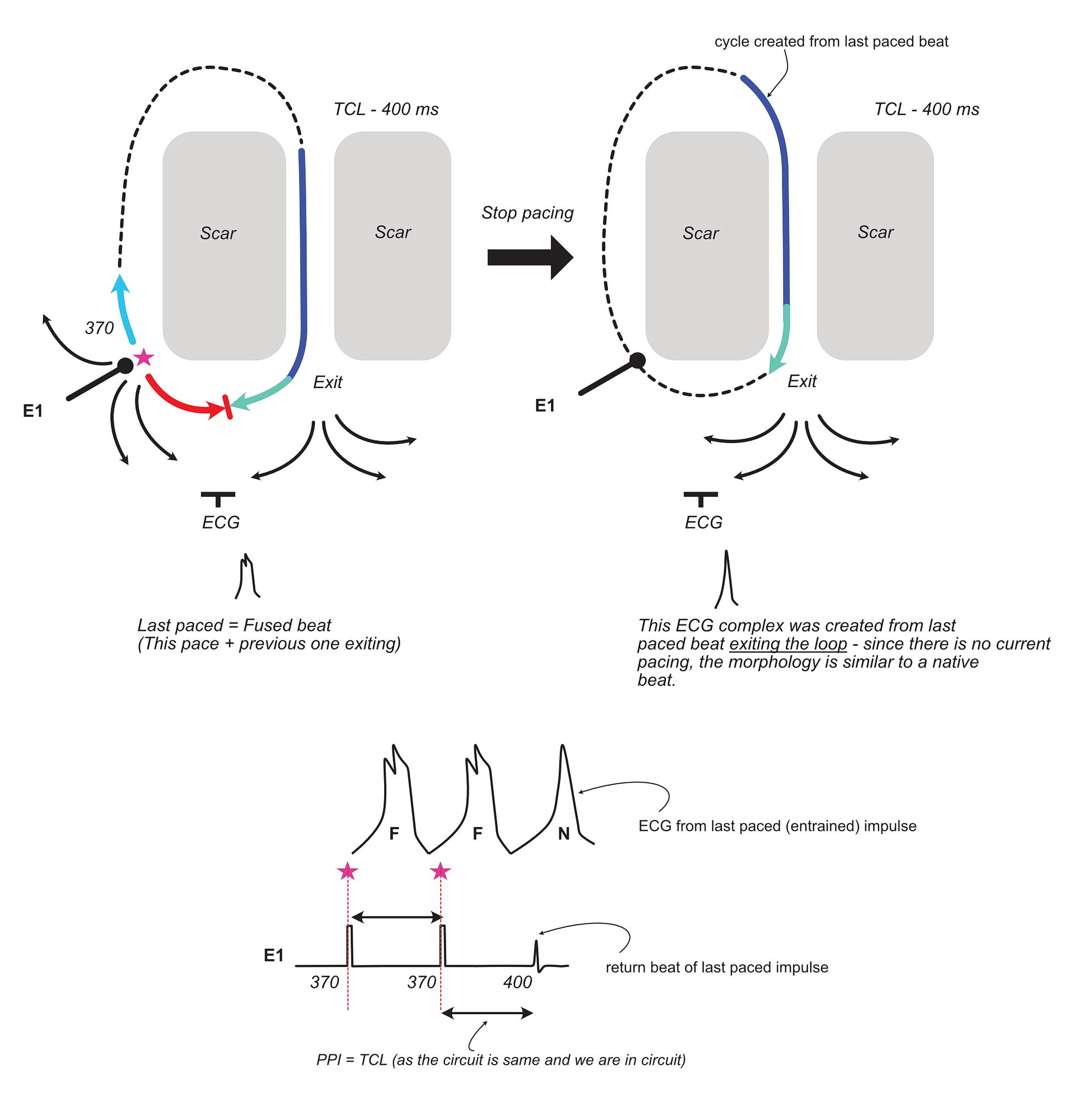 Schema on the behaviour of a re-entrant circuit after sudden cessation of entrainment