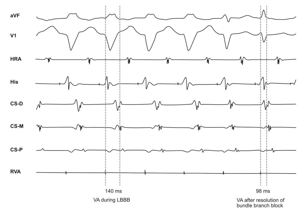 Effect of Bundle Branch Block on AVRT | EP Made Easy!