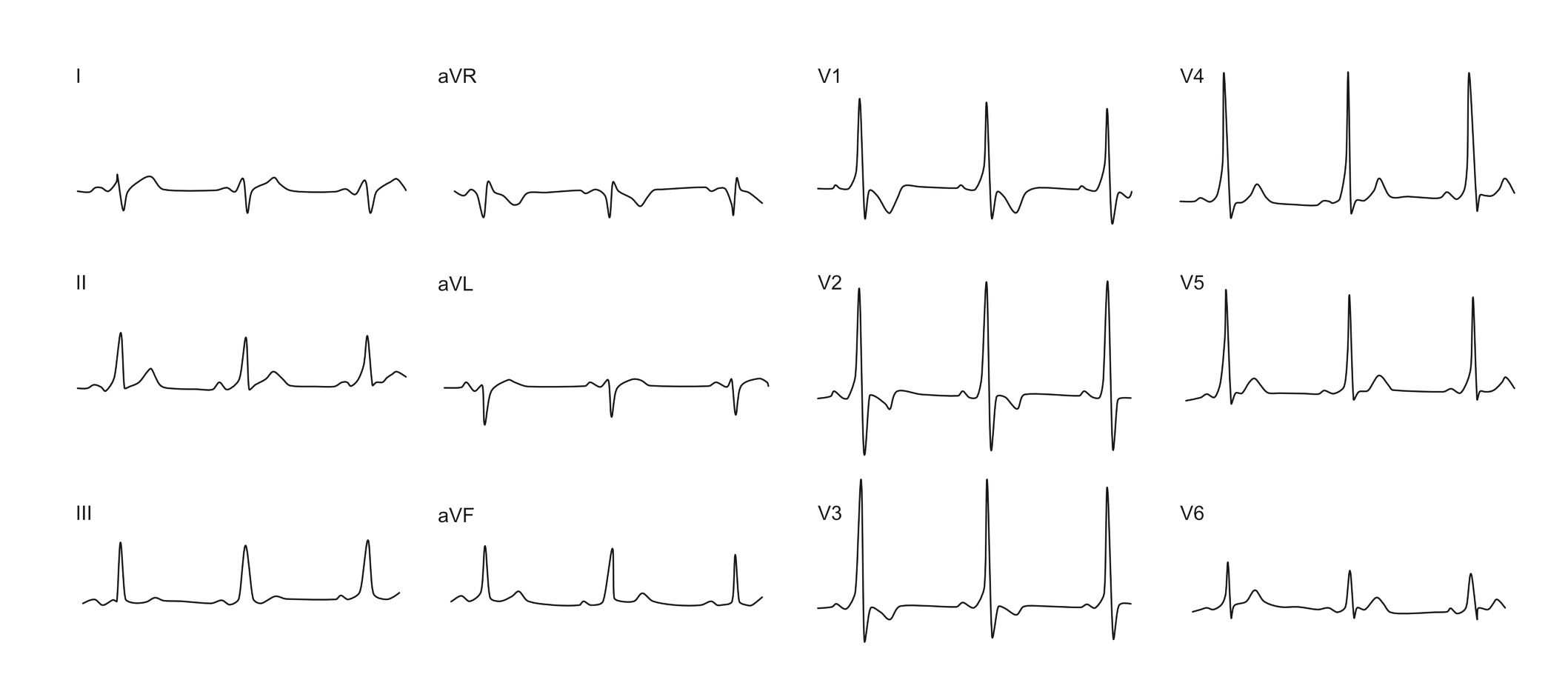 example of WPW ecg - left antero-lateral AP