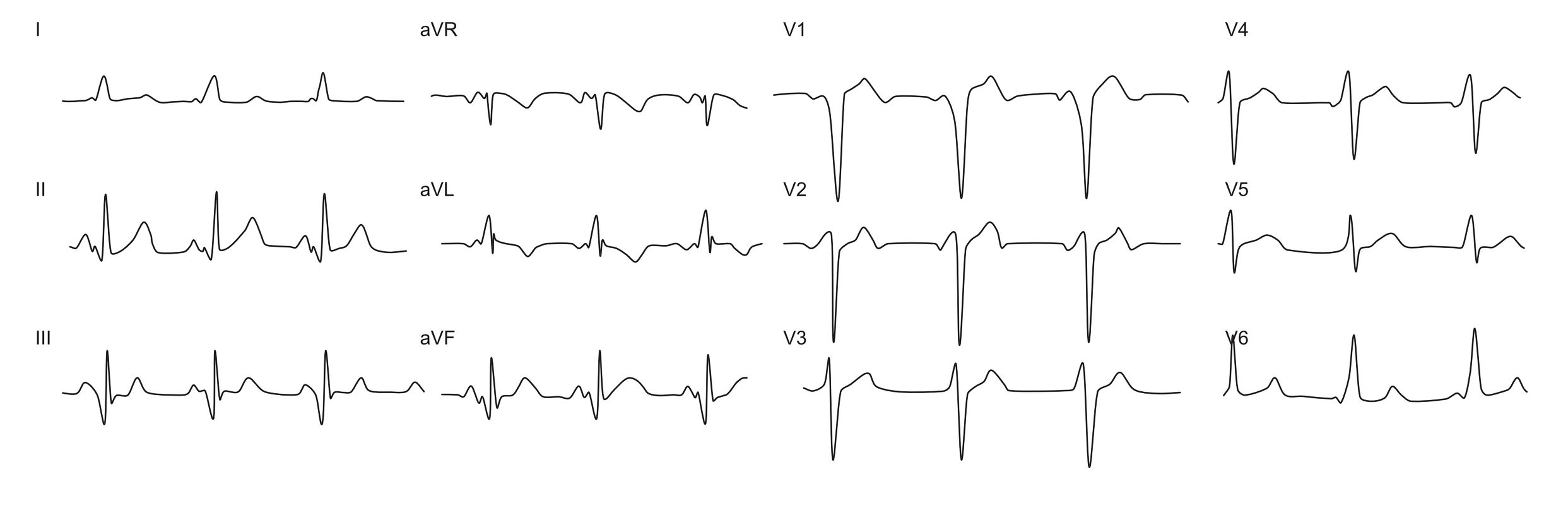 wpw ecg example right inferior AP